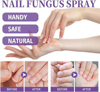 Thumbnail for Nail Fungus Spray